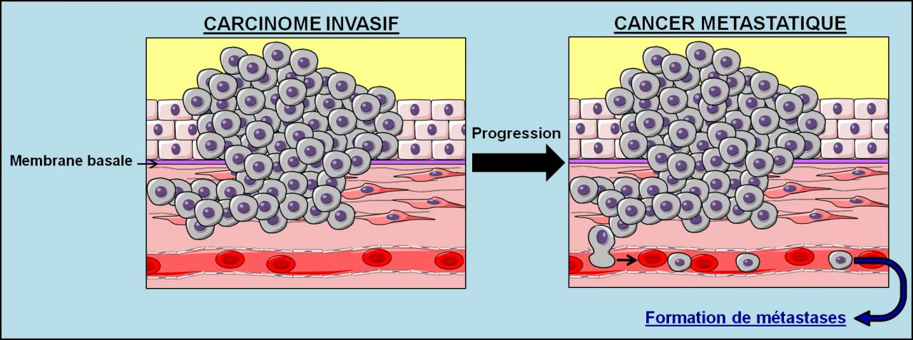 Schéma du processus métastatique