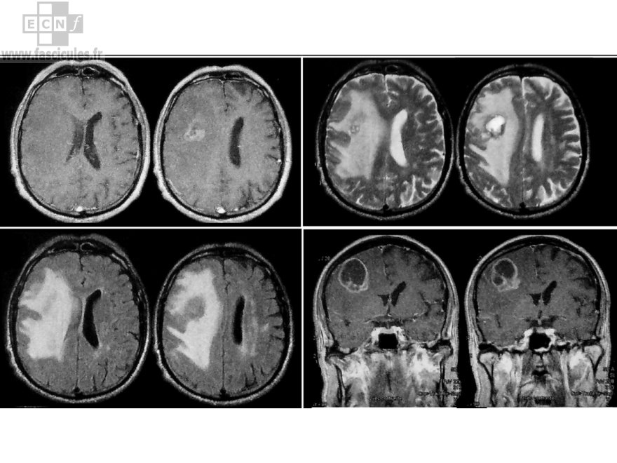 Neurologie IRM tumeur cérébrale