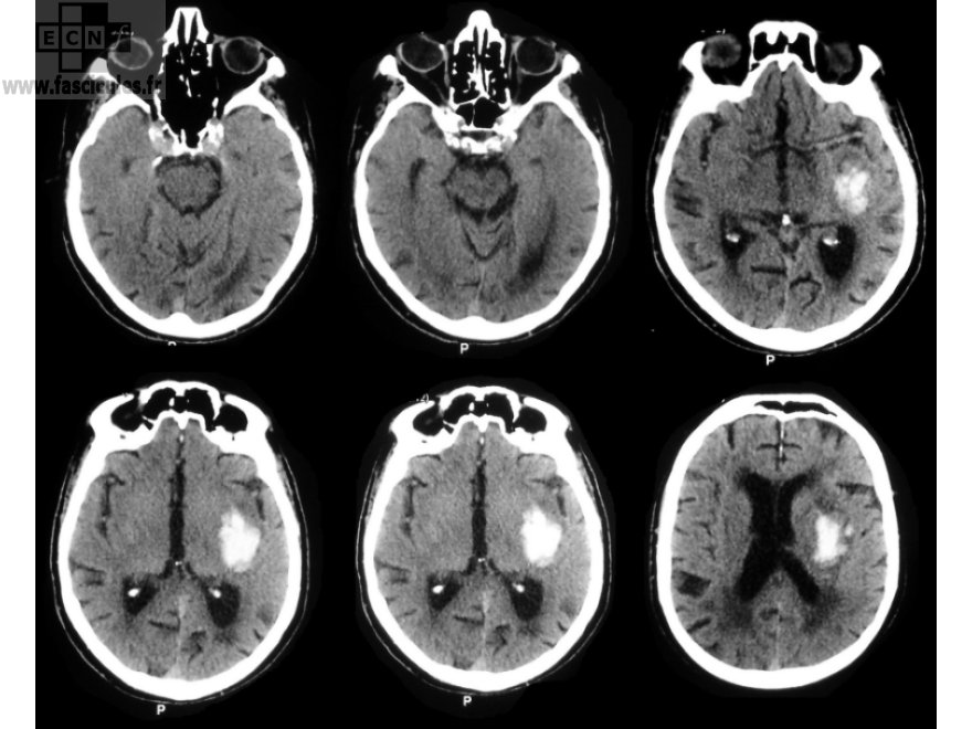 Neurologie scanner cérébral